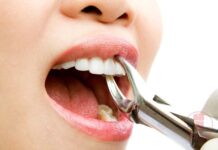 Nhổ răng mất thời gian bao lâu?