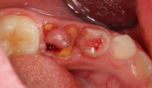 Bông tự tiêu sau khi nhổ răng là gì?
