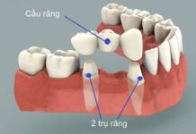 Không trồng răng giả sau khi nhổ răng có sao không?