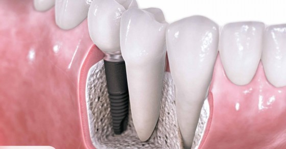 Nhổ Răng Hư Có Trồng Răng Implant Được Không?