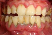 10 Cách để Loại Bỏ Cao Răng Tại Nhà