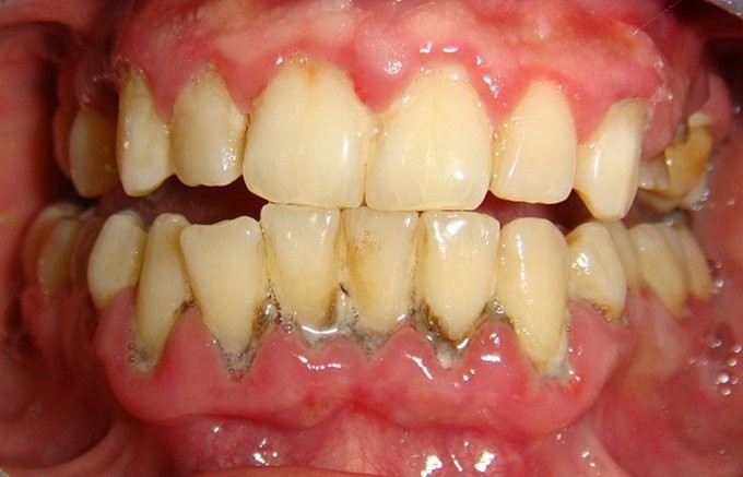 10 Cách để Loại Bỏ Cao Răng Tại Nhà