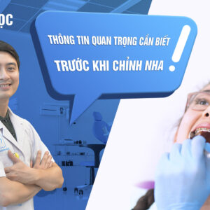 Niềng răng: 6 Thông tin quan trọng cần biết trước khi chỉnh nha