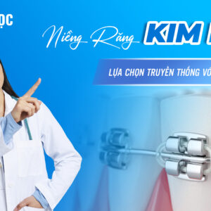 Niềng răng mắc cài kim loại