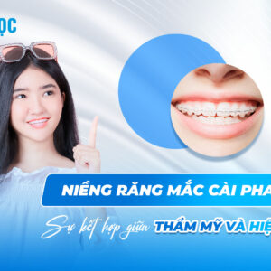Niềng răng mắc cài pha lê