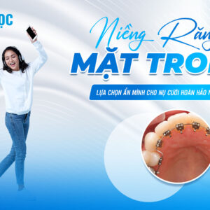 Niềng răng mặt trong