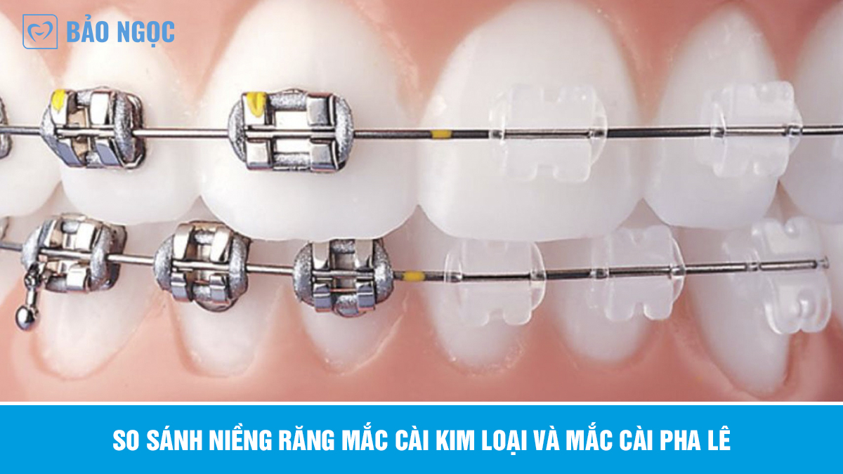 Niềng răng mắc cài pha lê