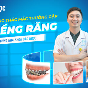 Những thắc mắc thường gặp về niềng răng