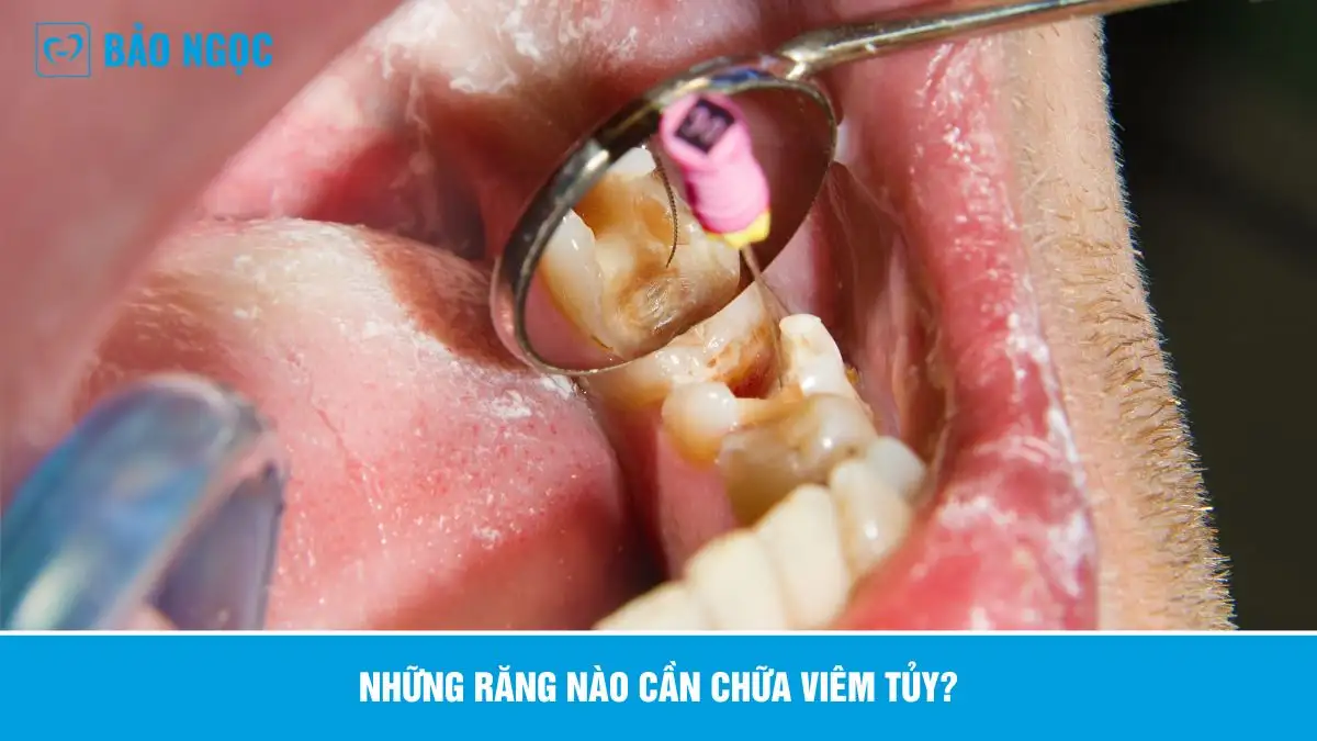 Điều Trị Tủy