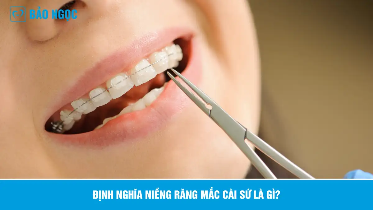 Niềng răng mắc cài sứ 