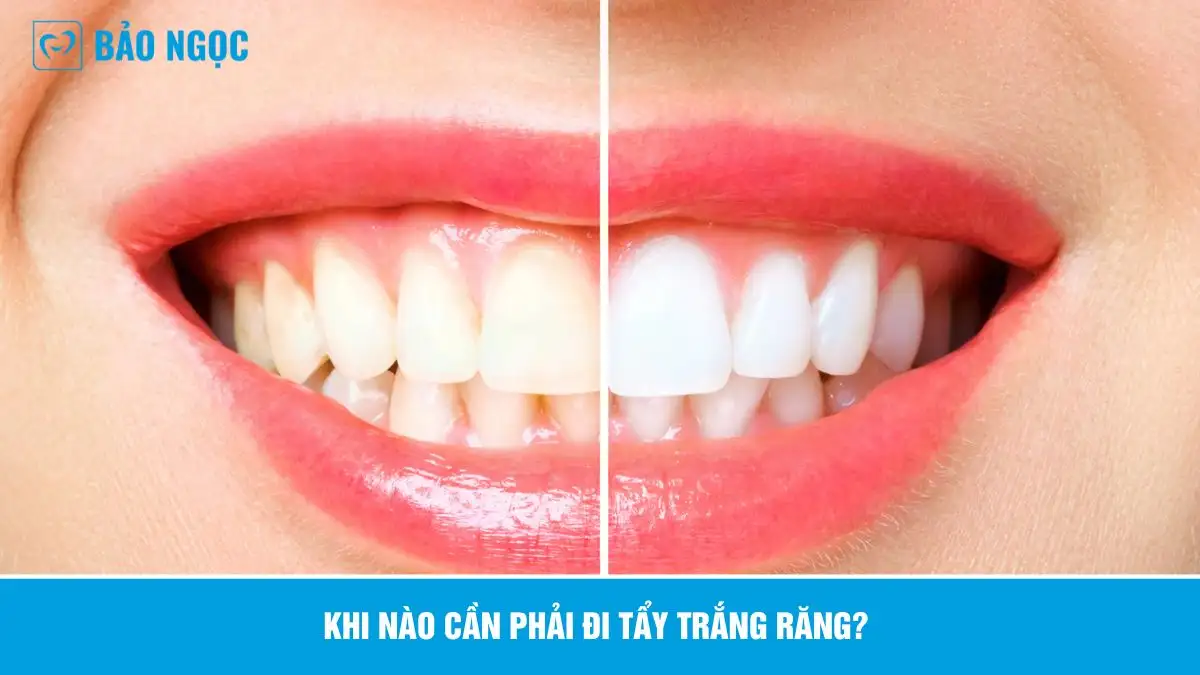 Tẩy trắng răng